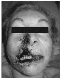 Necrose nasal e de lábio superior após uso de PMMA. rinoplastia - Necrose nasal e de lábio superior após uso de PMMA.