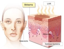 Melasma: Background, Pathophysiology, Epidemiology