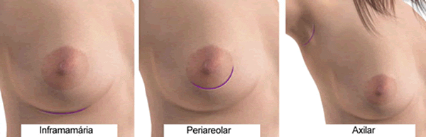 mamoplastia-de-aumento-4