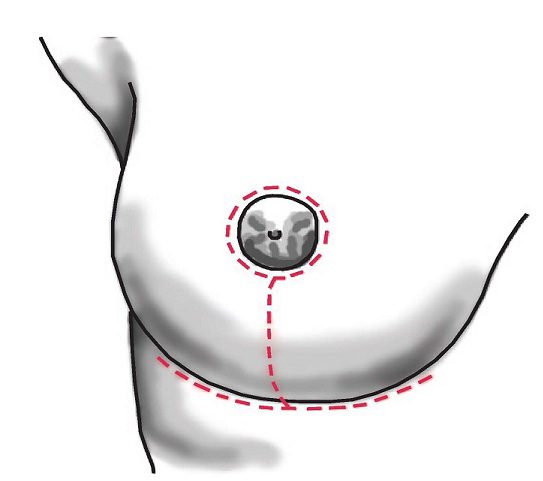 Cicatriz final de uma mamoplastia redutora