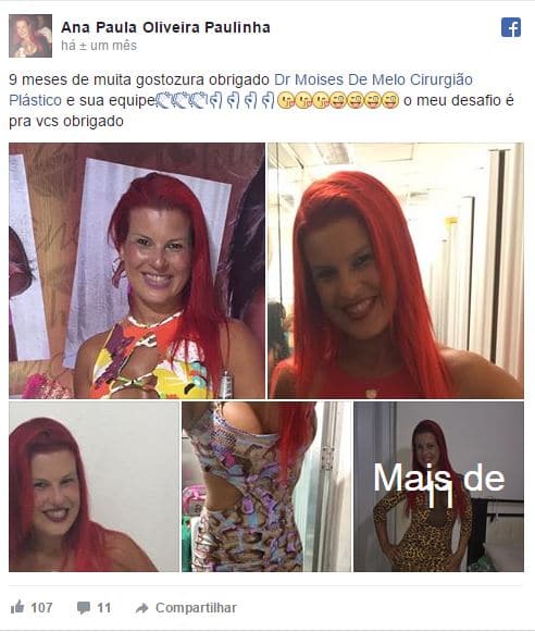 Ana Paula Oliveira Paulinha depoimento cirurgia plastica