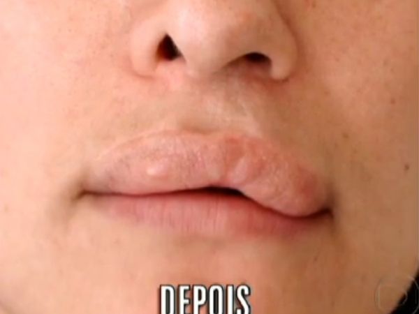 Bioplastia | Motivos para não fazer. Nódulo em lábio irreversível após preenchimento para "engrossar" os lábios.