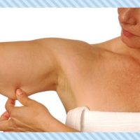 Braquioplastia: correção da flacidez e excesso de gordura nos braços