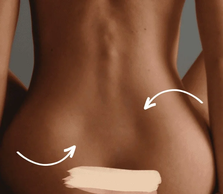 Lipo HD lipoaspiração de alta definição Lipo Lad. Após a separação da gordura, é feita a sua aplicação nos músculos de qualquer parte do corpo escolhida pelo paciente. Nesse outro exemplo temos o desenho da covinha de vênus, ou triângulo de Michaelis