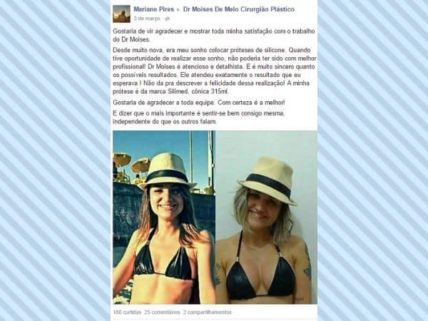 Mariane Pires depoimento cirurgia plastica
