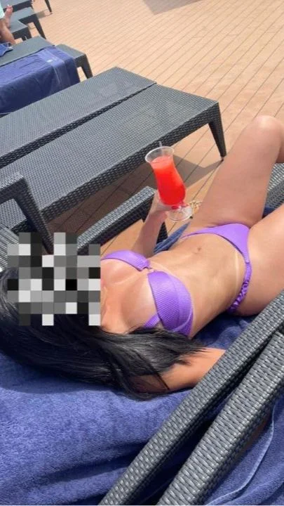 Resultado real de uma Lipo HD, mostrando como ficou após o resultado definitivo