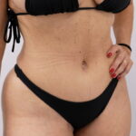 Abdome depois da abdominoplastia realizada pelo Dr. Moises de Melo