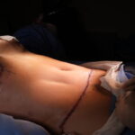 Resultado de abdominoplastia realizada pelo Dr. Moises de Melo, cirurgião plástico na Barra da Tijuca (RJ)