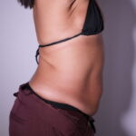 Resultado de abdominoplastia — abdome definido após cirurgia com o Dr. Moises de Melo
