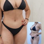 Resultado de abdominoplastia com o Dr. Moises de Melo, cirurgião plástico no Rio de Janeiro