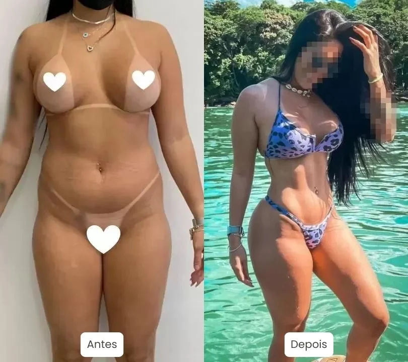 Antes e depois da Lipo HD, Lipo LAD. Foto original de cirurgia de Lipo HD feita por nossa equipe e Dr. Moises de Melo