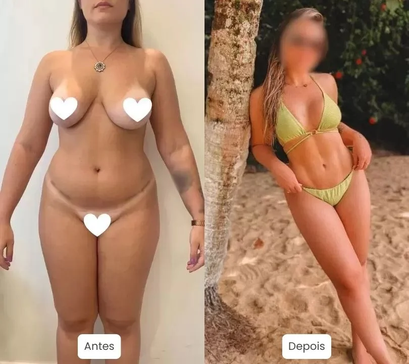 Antes e depois da Lipo HD, Lipo LAD. Foto original de cirurgia de Lipo HD feita por nossa equipe e Dr. Moises de Melo
