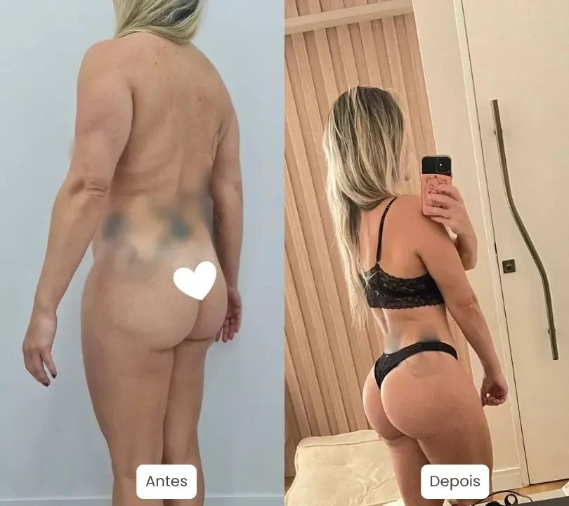 Antes e depois da Lipo HD, Lipo LAD. Foto original de cirurgia de Lipo HD feita por nossa equipe e Dr. Moises de Melo