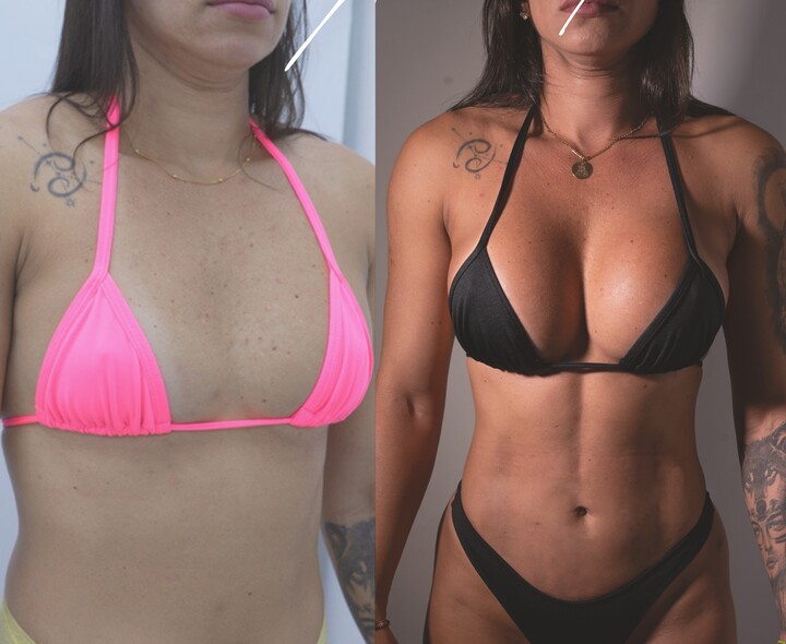 Antes e depois de mamoplastia de aumento com prótese de silicone, mostrando mudança no volume, colo e proporção corporal após planejamento cirúrgico.