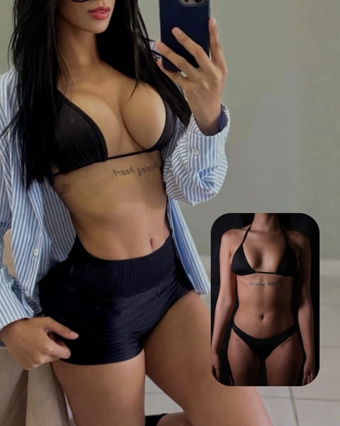 Foto real de antes e depois de cirurgia das mamas acompanhada pelo Dr. Moises De Melo.