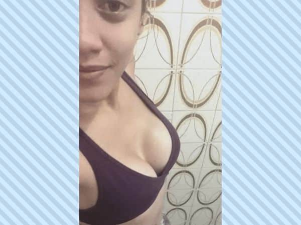 51 dias após a cirurgia de prótese de silicone - Por Ana Vieira