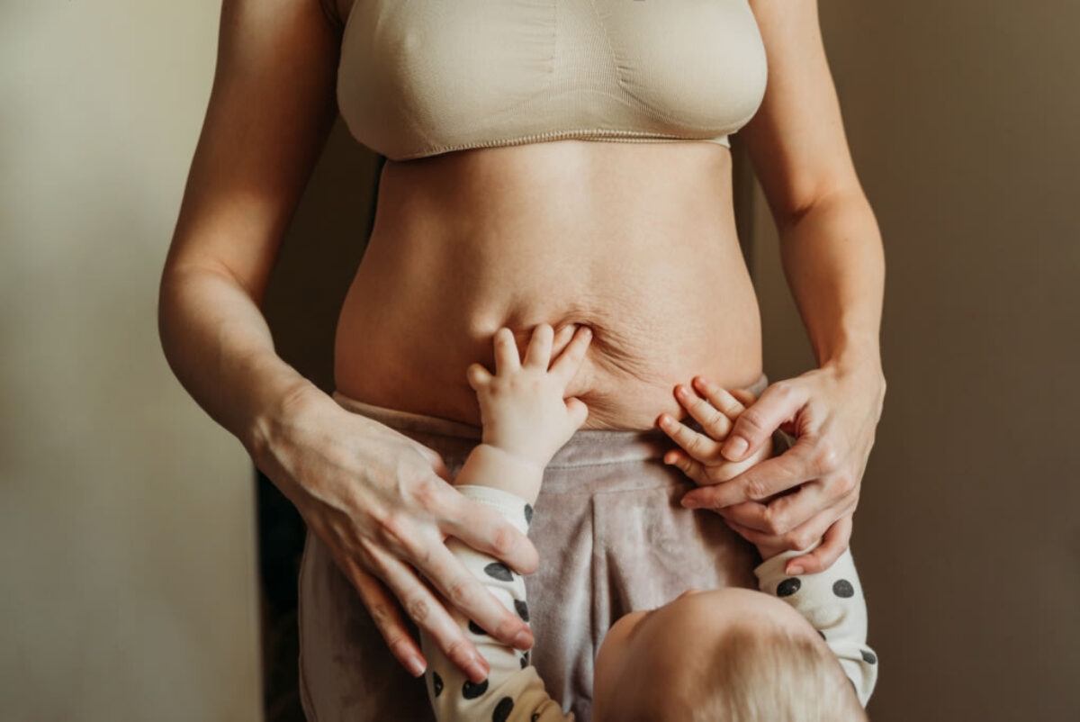 Diástase com recomendação de abdominoplastia para resolução do problema e melhoria estética