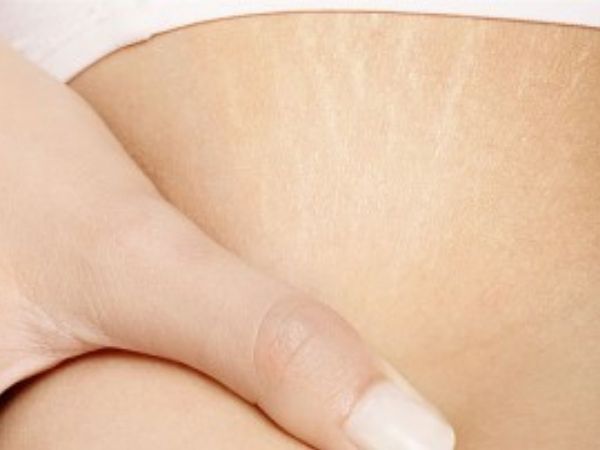 Como prevenir las estrias por bajar de peso Como prevenir las estrias por bajar de peso