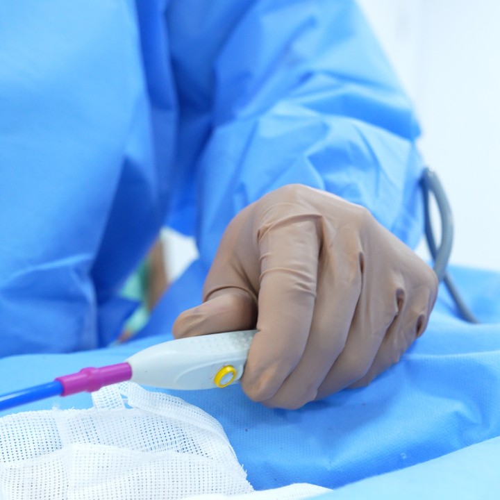 Procedimento de retração de pele com jato de plasma de argônio