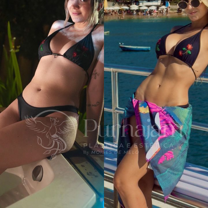 Lipo HD antes e depois – resultados reais da paciente Cailane, operada pelo Dr. Moises De Melo. Foto de antes e depois