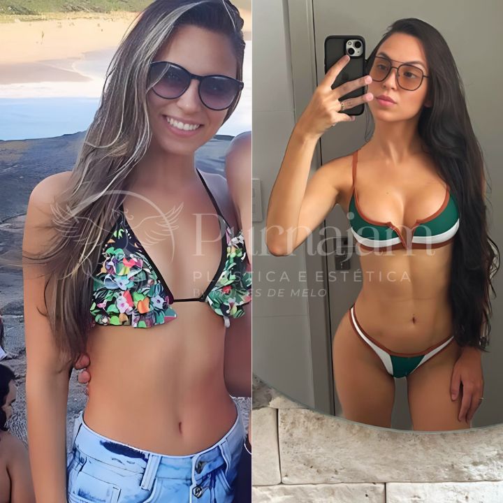Antes e depois da Lipo HD da paciente Letícia – Dr. Moises De Melo. Confira a foto comparativa do resultado real.