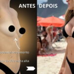 Mamoplastia de aumento com prótese antes e depois — resultado do Dr. Moises de Melo