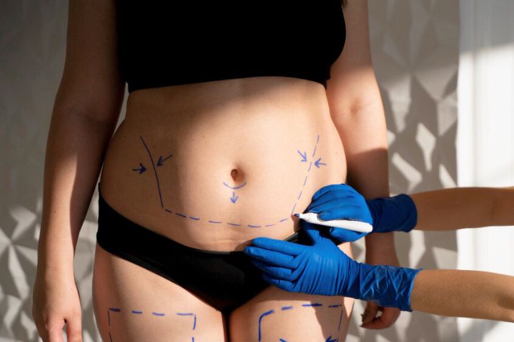 Marcações no corpo para abdominoplastia indicam a previsão dos resultados, os reposicionamentos e a retirada de gordura e pele.