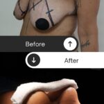 Mastopexia com prótese antes e depois — resultado de mamoplastia com o Dr. Moises de Melo