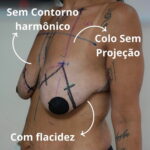 Resultado de mastopexia com prótese realizada pelo Dr. Moises de Melo