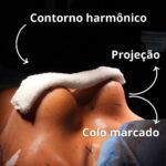Resultado de mastopexia com prótese de silicone com o Dr. Moises de Melo, no Rio de Janeiro