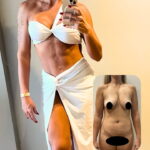 Mini abdominoplastia antes e depois — resultado com o Dr. Moises de Melo