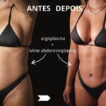 Mini abdominoplastia antes e depois — abdome inferior definido com o Dr. Moises de Melo