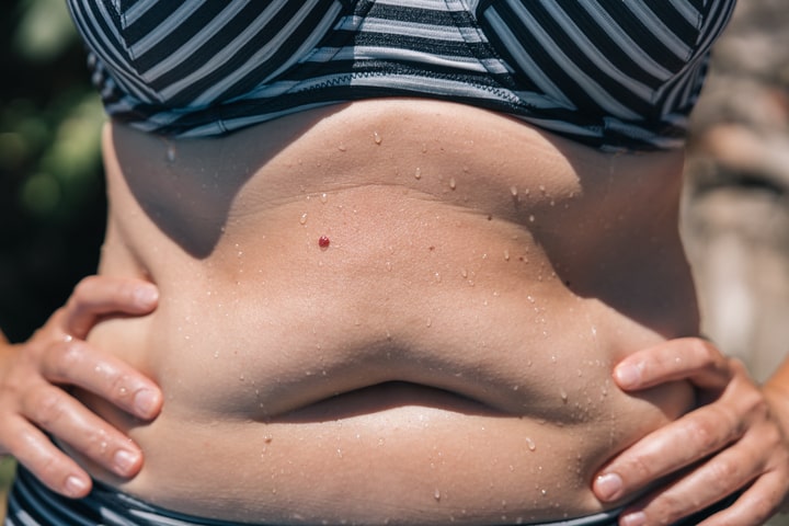 Mulher com barriga moderadamente volumosa e flácida