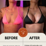 Prótese de silicone antes e depois — mamoplastia de aumento com o Dr. Moises de Melo, Rio de Janeiro