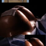 Resultado de mamoplastia de aumento com prótese de silicone — Dr. Moises de Melo